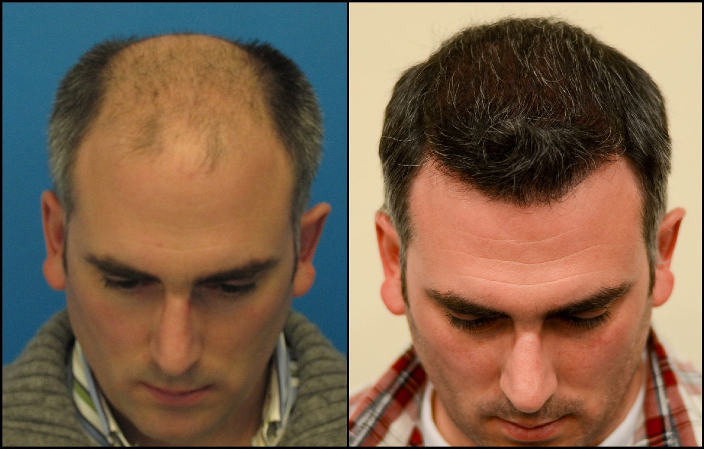 Dr. Hasson/8402 Grafts/One Session/ 11 Months - Results Posted by Leading  Hair Restoration Clinics - Hair Restoration Network - Community For and By  Hair Loss Patients