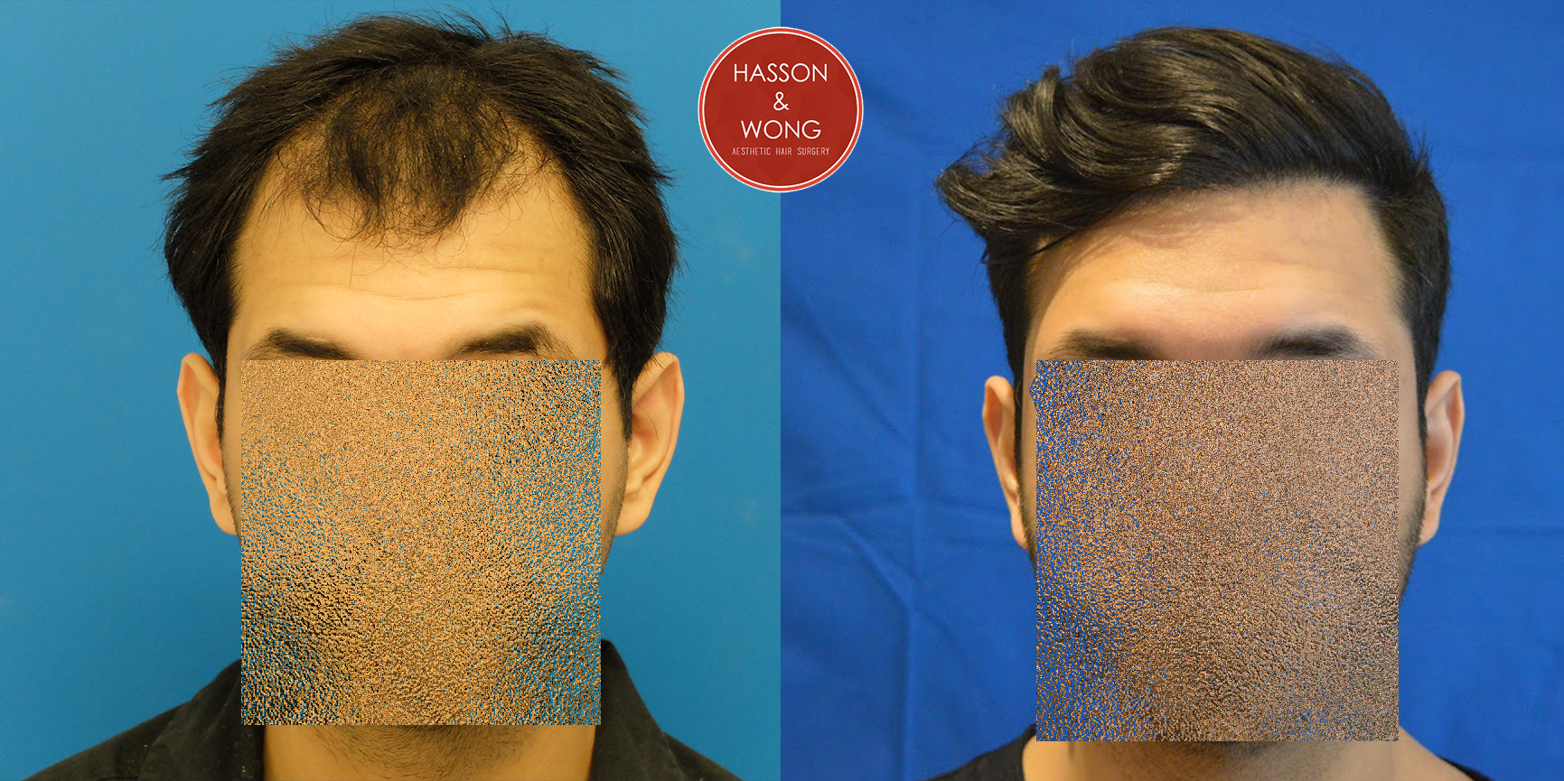 hair-transplant-before-and-after-dr-hasson--1.jpg