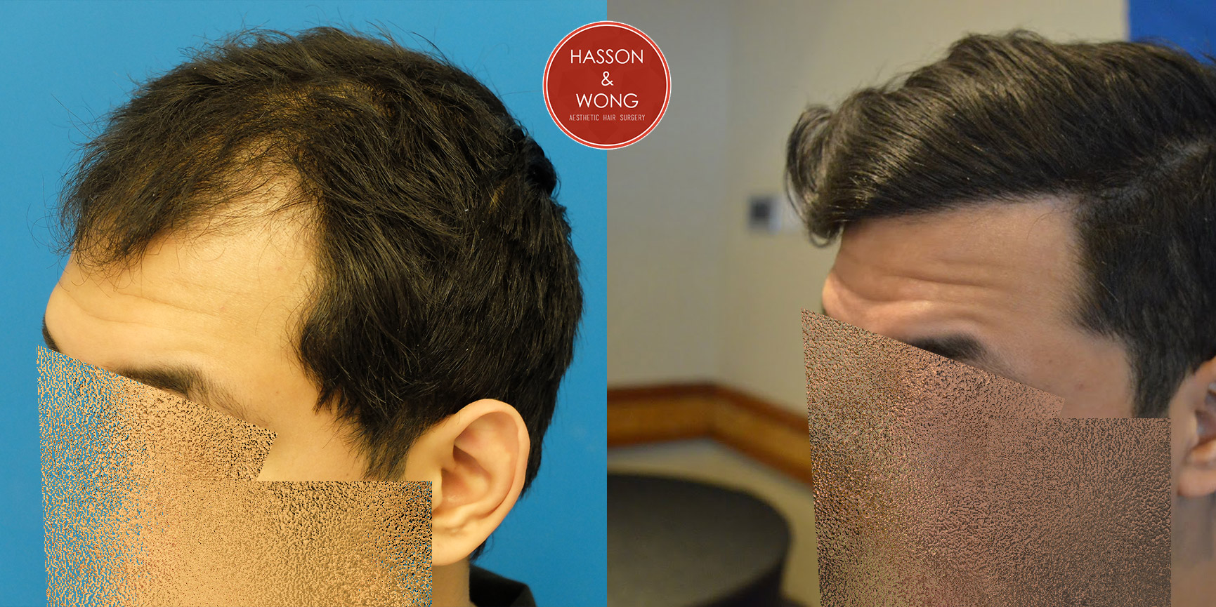 hair-transplant-before-and-after-dr-hasson--2.jpg