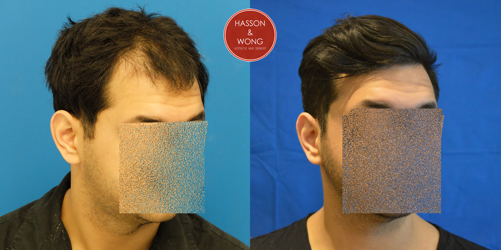 hair-transplant-before-and-after-dr-hasson--3.jpg