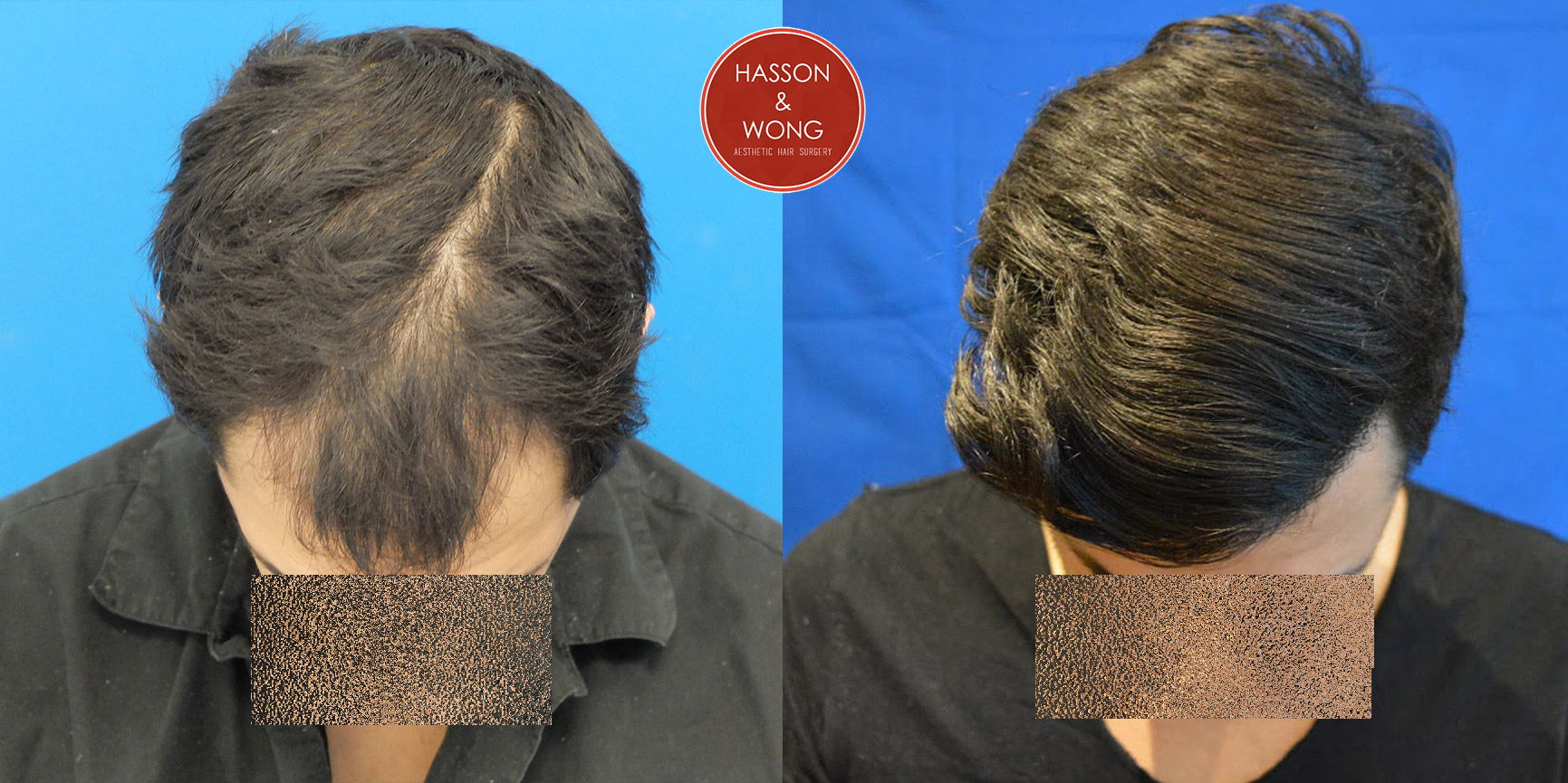 hair-transplant-before-and-after-dr-hasson-5.jpg