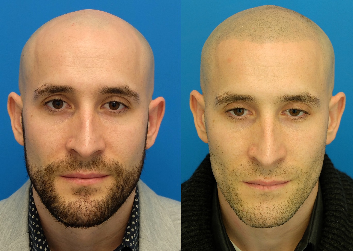 H&W/NuYuInk SMP - Scalp Micropigmentation (SMP) - Hair Restoration Network  - Community For and By Hair Loss Patients
